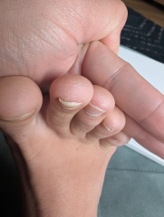 Toenails falling off and bulbus tip (pics attached)