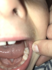 Toddler molar problem potentially