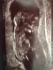 Nub theory guesses 12 week scan 💕💙