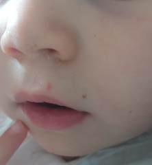 Is this a coldsore on my toddler?
