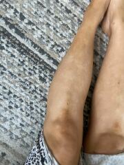 White blotchy gradual tan, please help!
