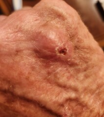 Do I need an antibiotic?