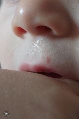 Is this a coldsore on my toddler?