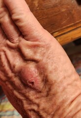 Do I need an antibiotic?