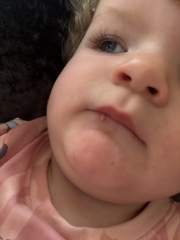 Cut that turned into a white blister?