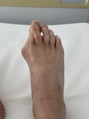 Shoes for bunions - which brands are best?