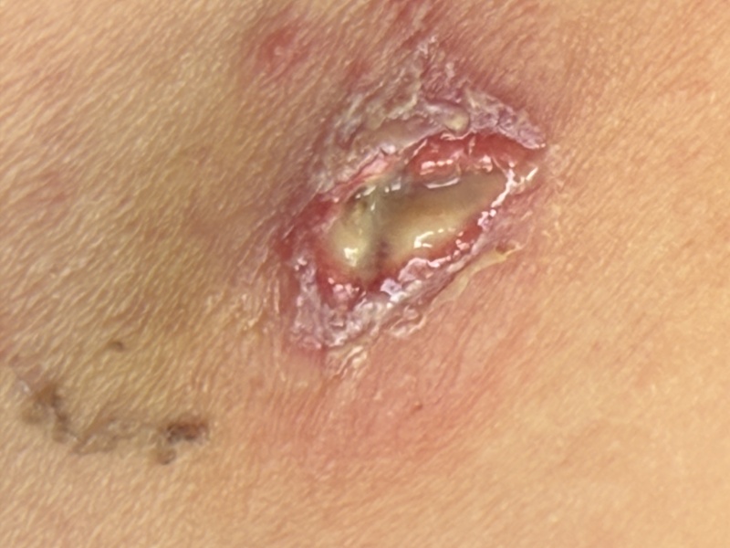 Infection wound post surgery?!
