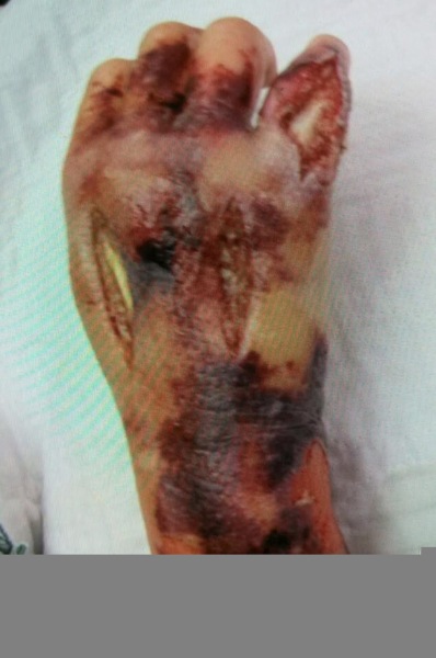 Do I need an antibiotic?