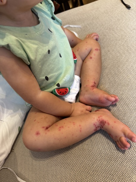 Please can anyone help ?! In hospital abroad with sick baby ( graphic pictures)