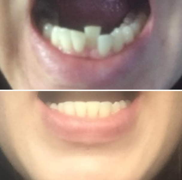 Invisalign - is it worth the money?