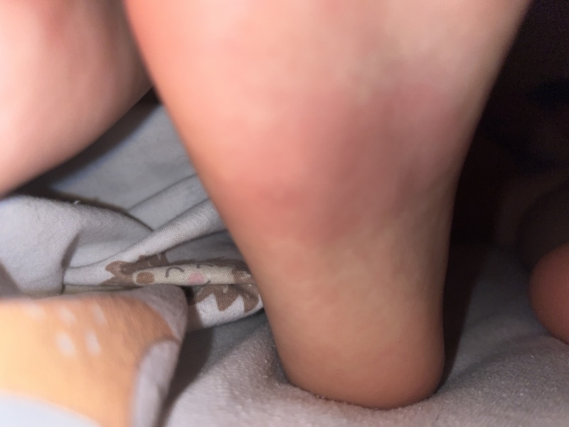 Insect Bite Diagnosis help!