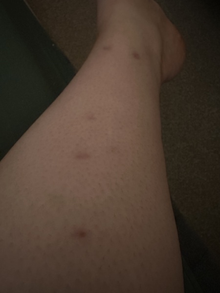 Marks on legs after pregnancy