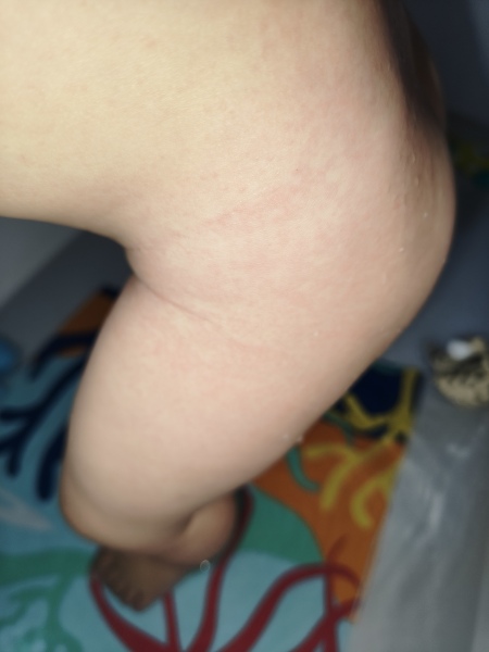 What is this rash please?