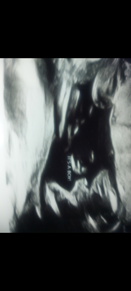 Gender scan- struggling to see clearly