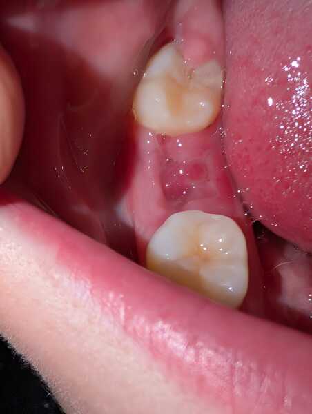 Tooth extraction healing
