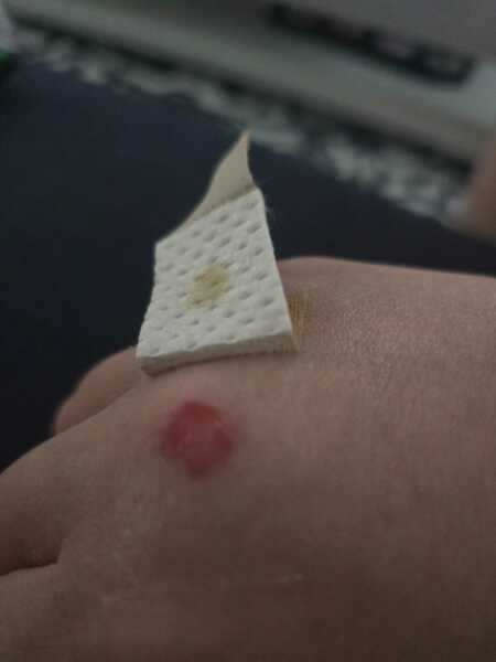 Hot glue gun burn