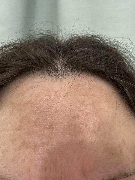 Best product for pigmentation