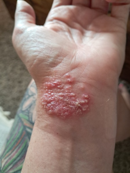 Contact Dermatitis? Please help!