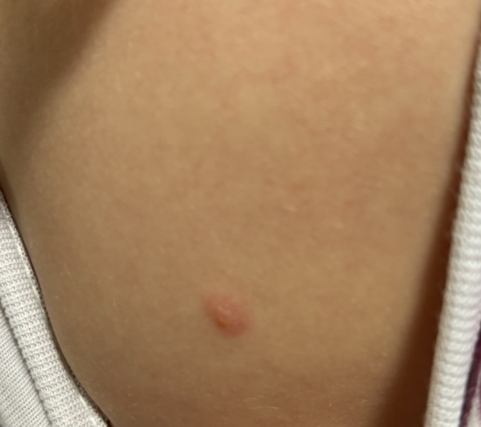 To ask if this looks like the start of chicken pox?