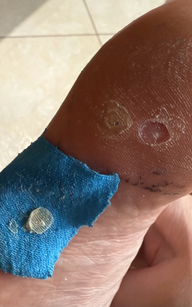 Verruca advice please - gross photo included