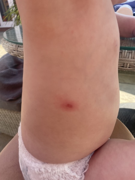 Any ideas what this rash is?
