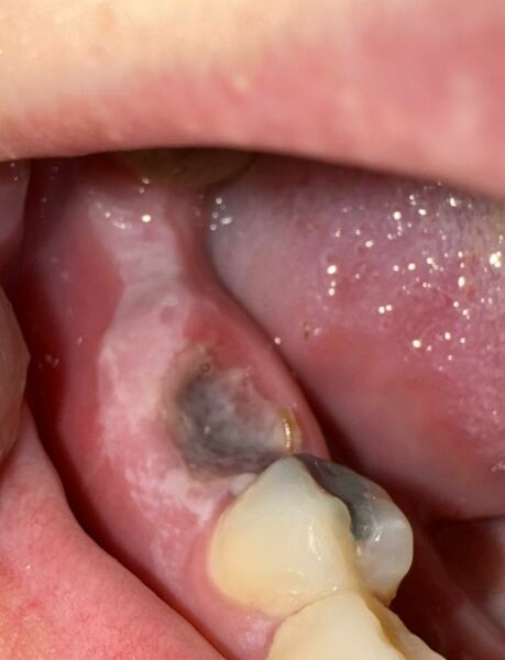 Dry socket (photo included)