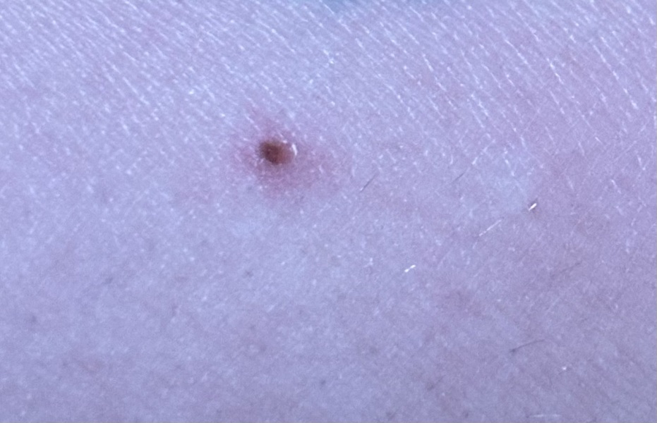 To ask what this on my arm could be?