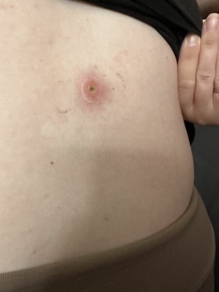 *pic nsfw* spinal condition, back sore, infected?