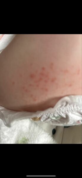DD has a rash, any ideas?