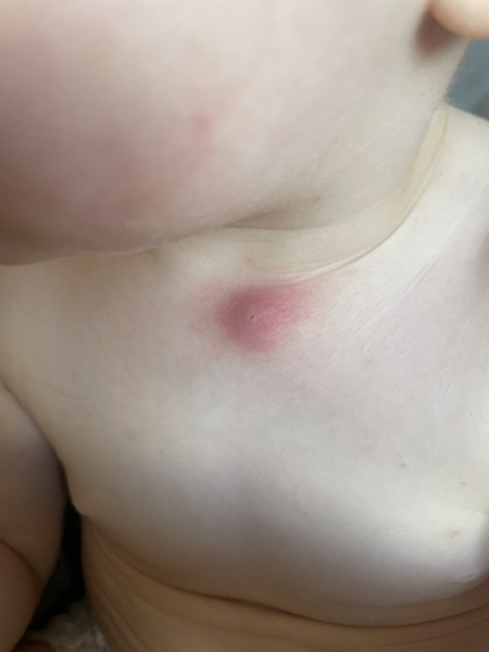 DS 16 months has an infected cyst - what else can I do? (Picture attached)