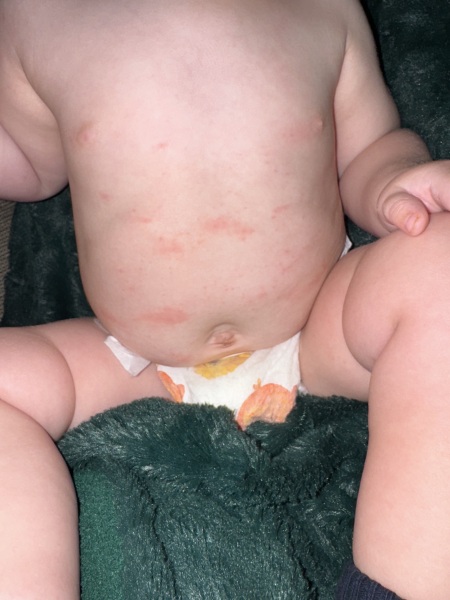 Rash on 8 month baby
