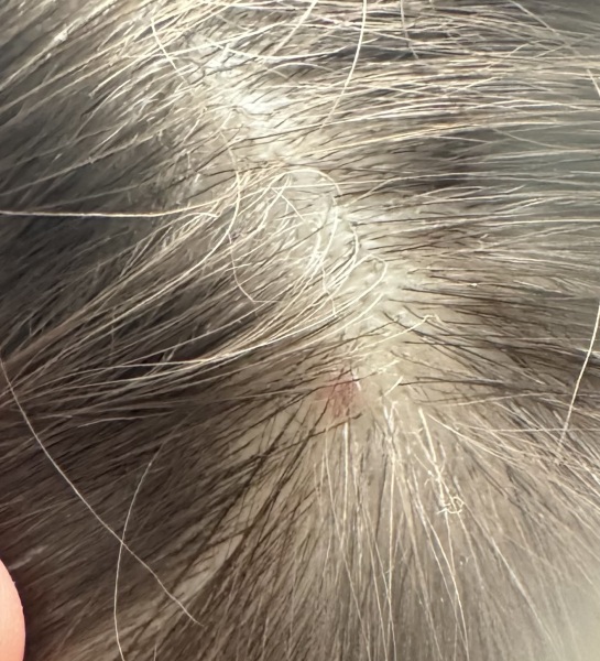 Sore itchy red bump on scalp