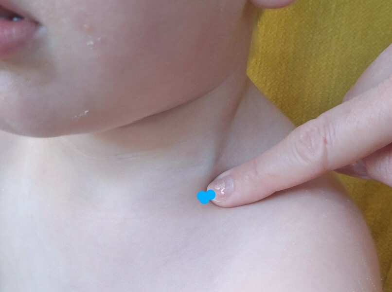 Need a handhold - multiple palpabale lymph nodes and weight loss toddler