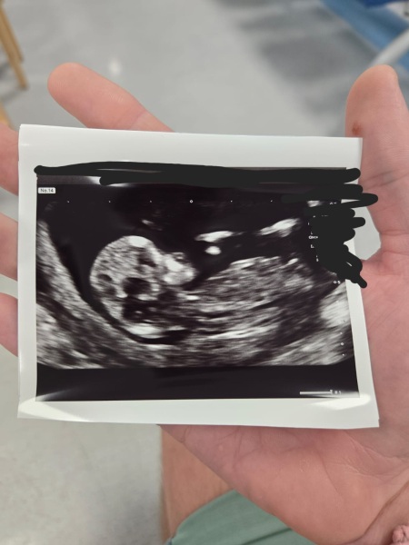 Boy or girl? Nub theory?
