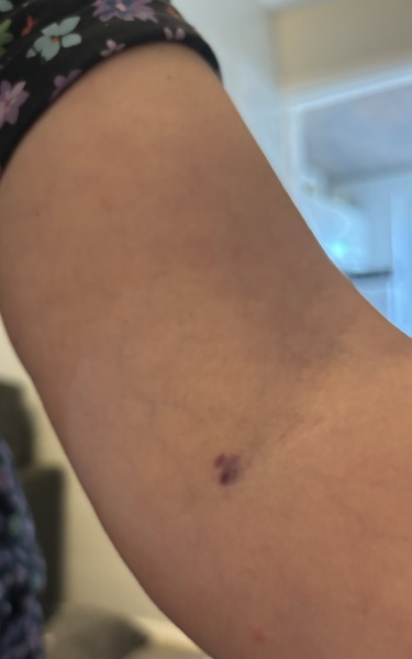 To be worried about this on my mums arm?