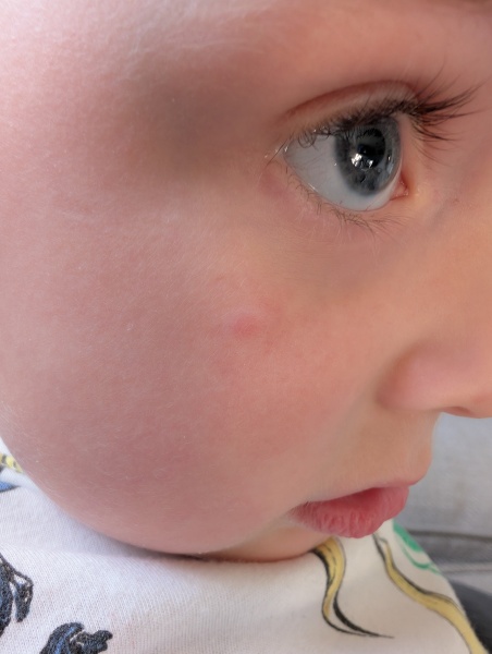 Chickenpox?