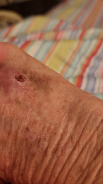 Do I need an antibiotic?