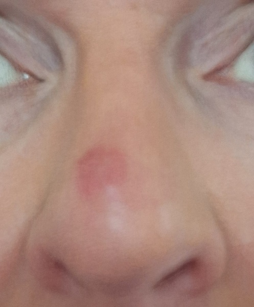 Fly bite on my nose