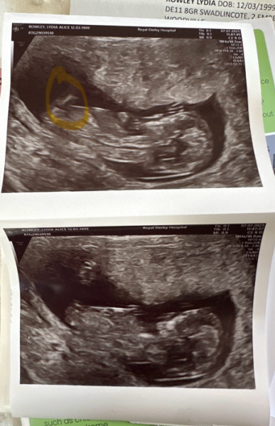 Boy or girl? Nub Theory? Skull Theory? ? ? help!!!