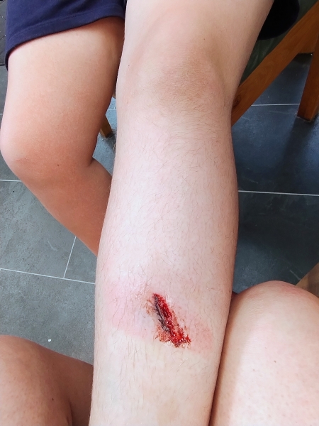 Any wound experts out there? (includes pic - warning!)
