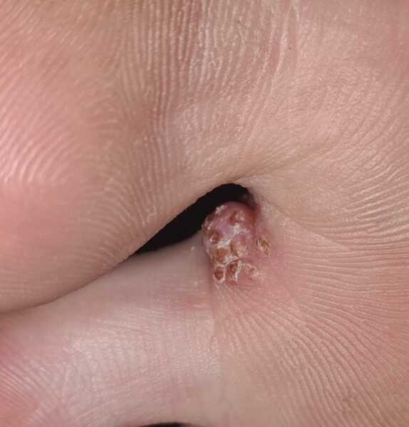 WTF is this between teenage son's toes?? Yucky pic warning