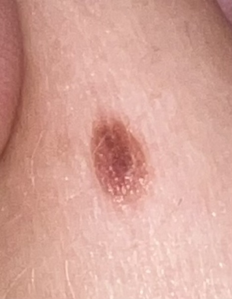 Unsure on this mole