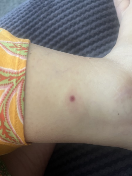 What do I need to do for a tick bite?