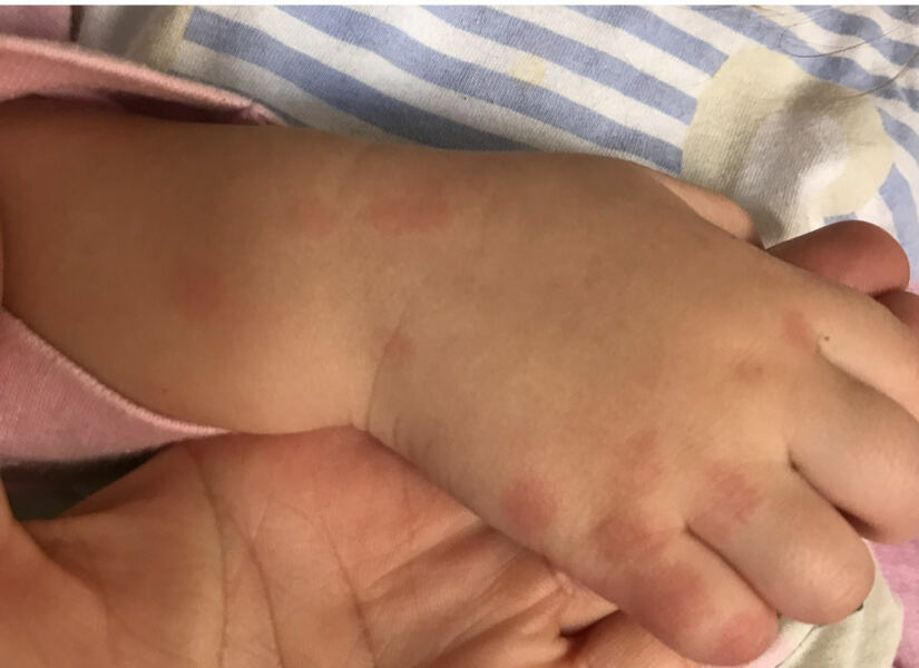 Bed Bugs?