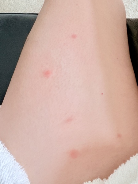 Bites