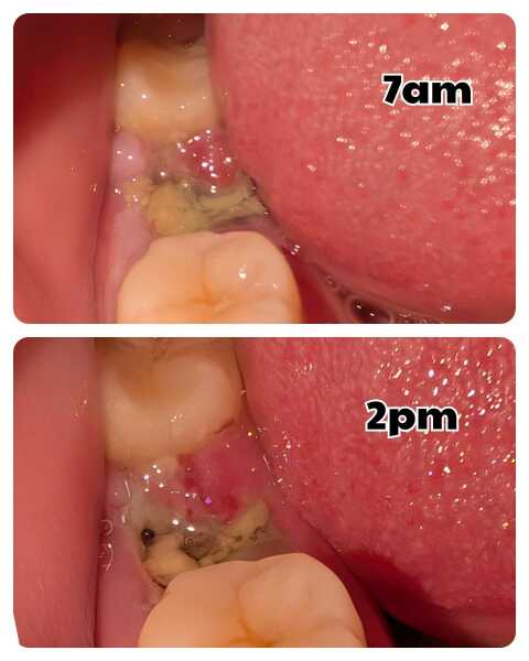 Tooth extraction healing