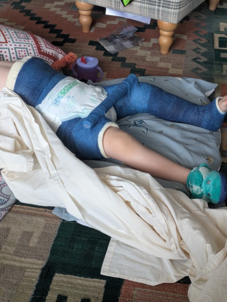 Hip Spica advice please