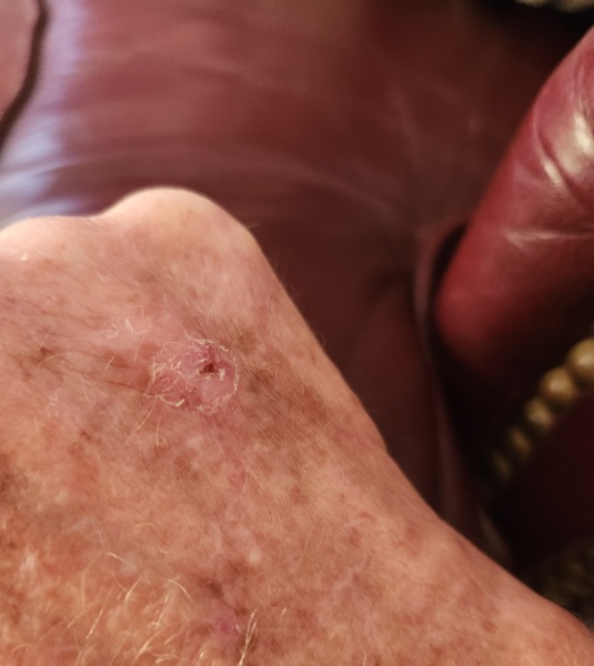 Do I need an antibiotic?