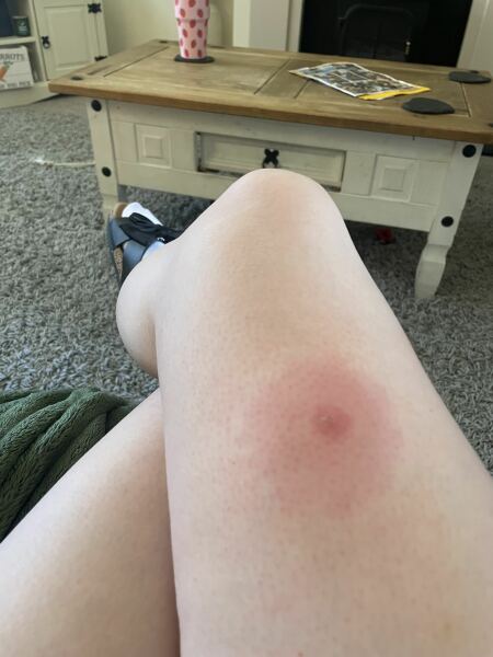 Identify my bites!