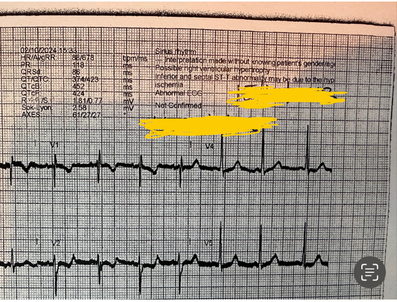 DD’s ECG abnormal! But no one told us!! Can anyone help??
